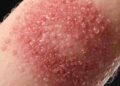 Allergia al nichel: attenzione a collane, bracciali e gioielli che possono irritare la pelle