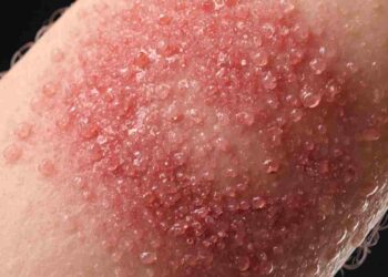 Allergia al nichel: attenzione a collane, bracciali e gioielli che possono irritare la pelle