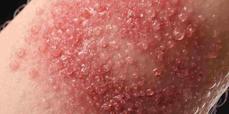 Allergia al nichel: attenzione a collane, bracciali e gioielli che possono irritare la pelle