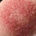 Allergia al nichel: attenzione a collane, bracciali e gioielli che possono irritare la pelle