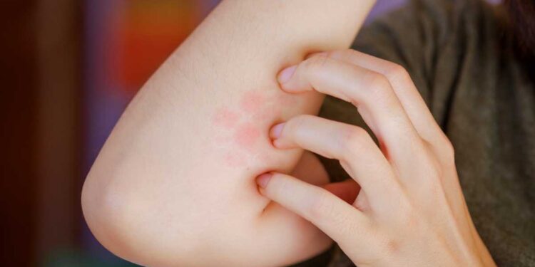 Sos estate: Come proteggere la tua pelle dalle bolle da calore (e dire addio al prurito)